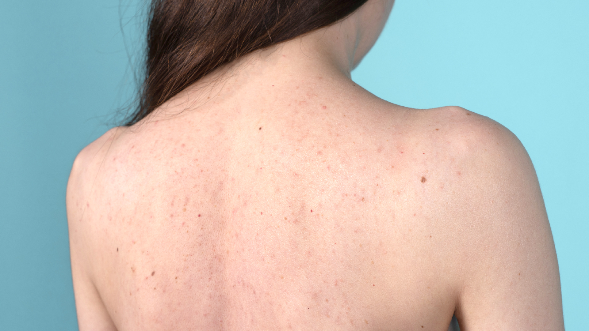 How to clear up back acne (backne)