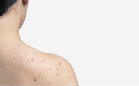 What is “Bacne” and how do you get rid of it?