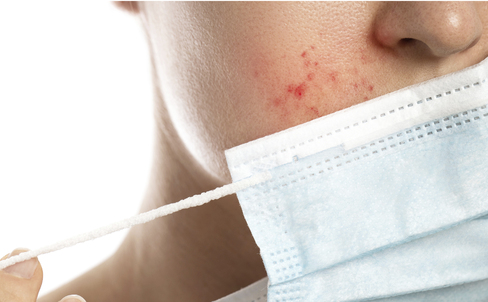 What is “Maskne” and how do you avoid it?