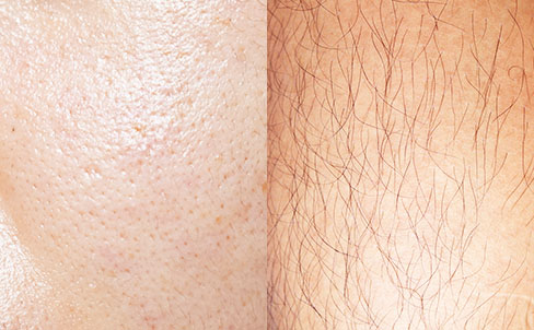 How IPL can reduce the side effects of hormonal changes