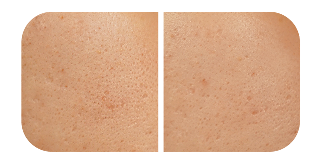 Reduce Acne & Scarring