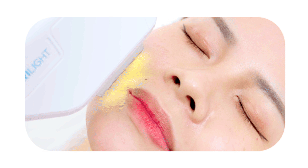 Targeting Epidermis with Pulsed Light