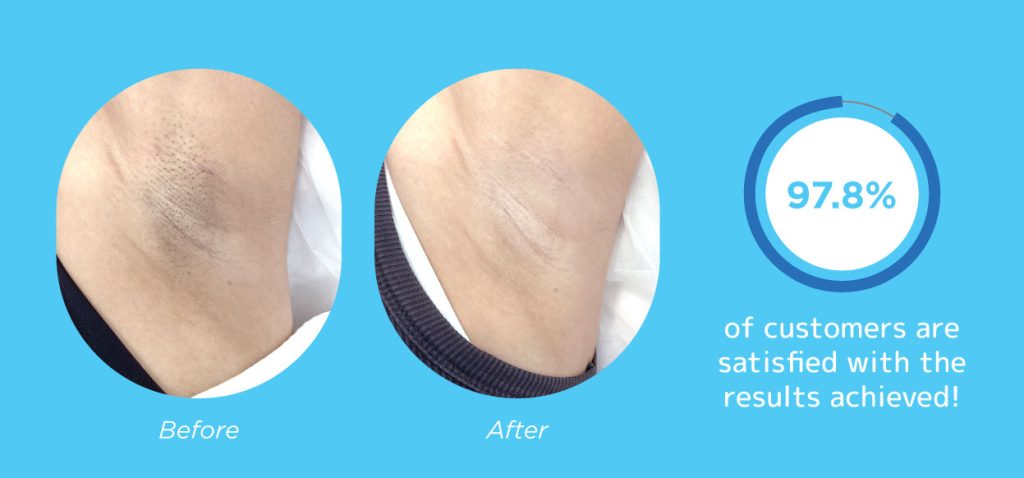 ADLight™ Hair Removal at Japan IPL Express Jem