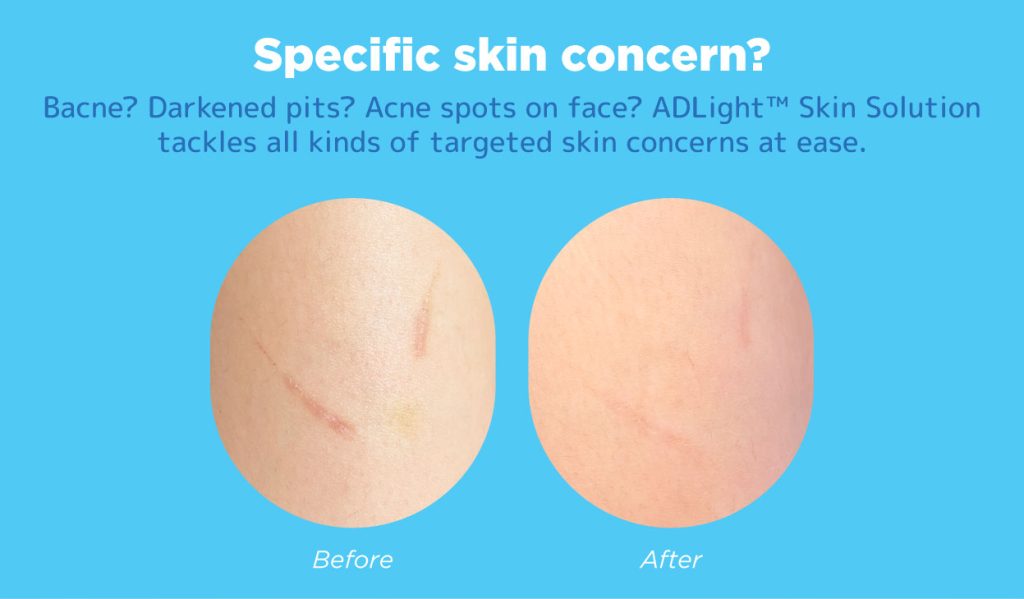 ADLight™ Skin Solution at Japan IPL Express Jem