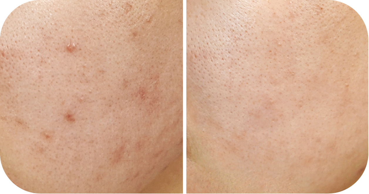 Reduce Acne & Scarring