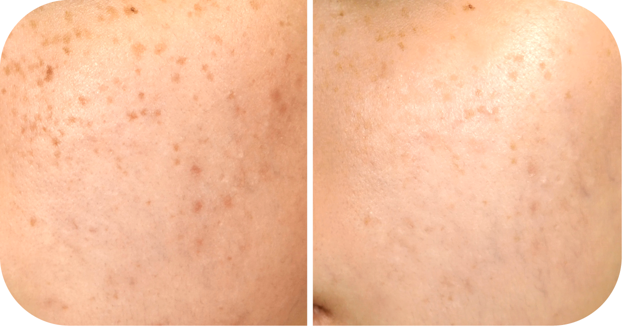 Lighten Pigmentation