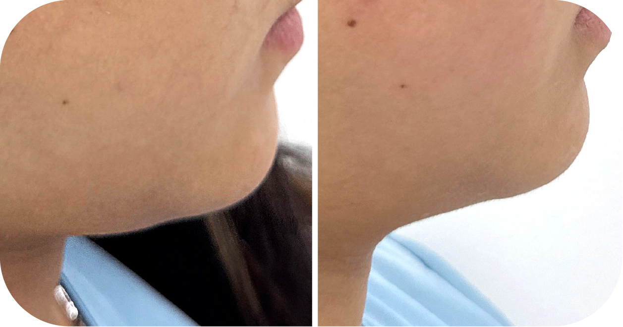 Lift, Tighten & Strengthen Skin