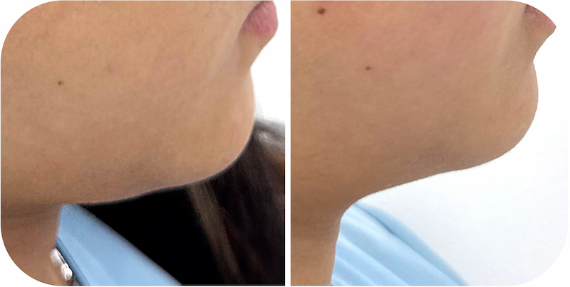 TriLight Therapy Before After at Japan IPL Express