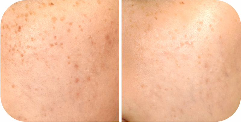 TriLight Therapy Before After at Japan IPL Express