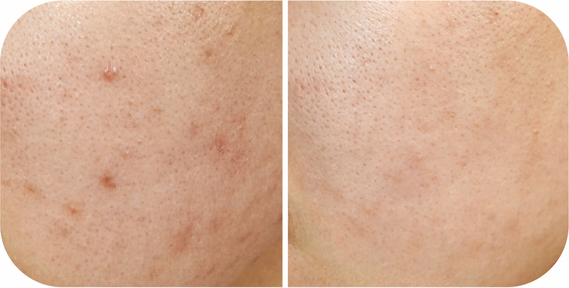 TriLight Therapy Before After at Japan IPL Express