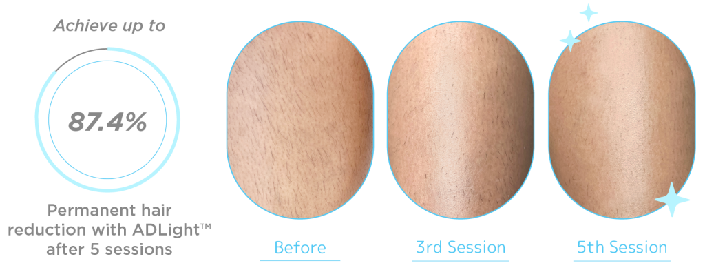 Underarm progressive results